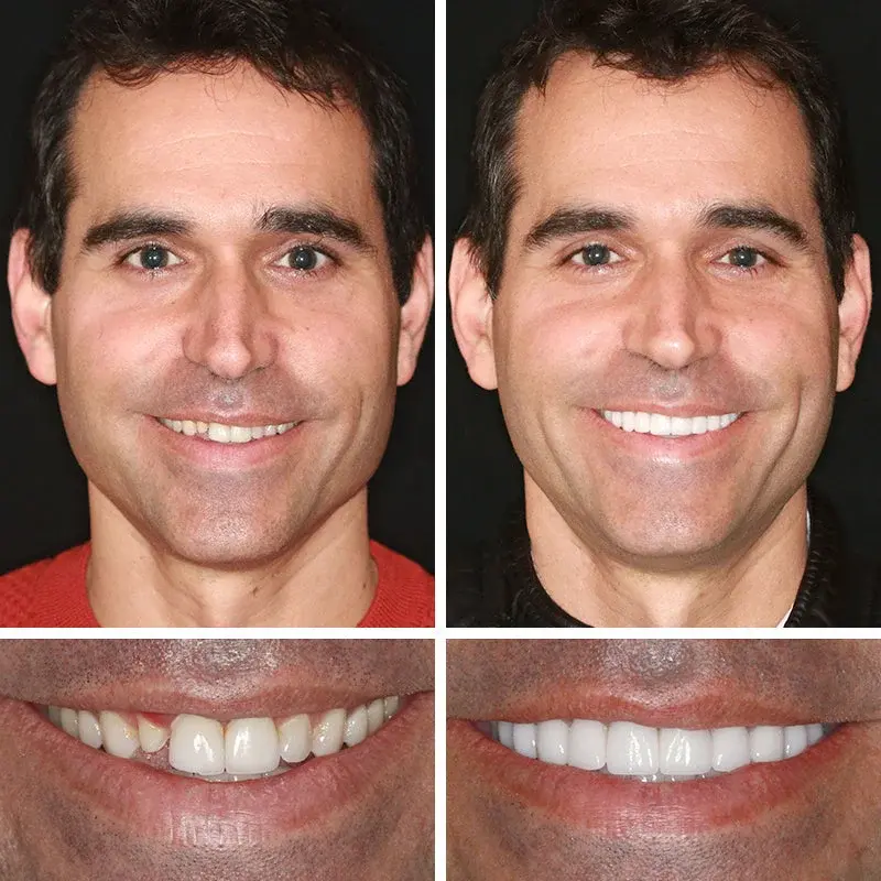 Advanced Customized Full Denture Set - Image 7