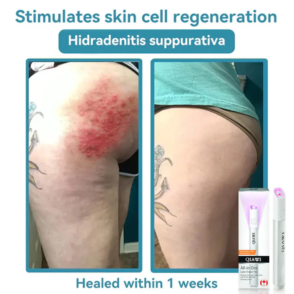 All-in-One CO₂ Laser Eraser Pen - Image 6