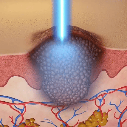 non-invasive laser pen delivers hospital-grade results at home - Image 13