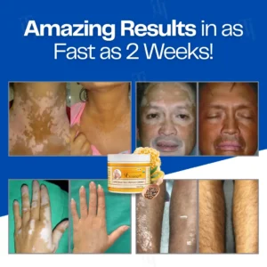 Alternative view of VitiClear Bee Venom Cream