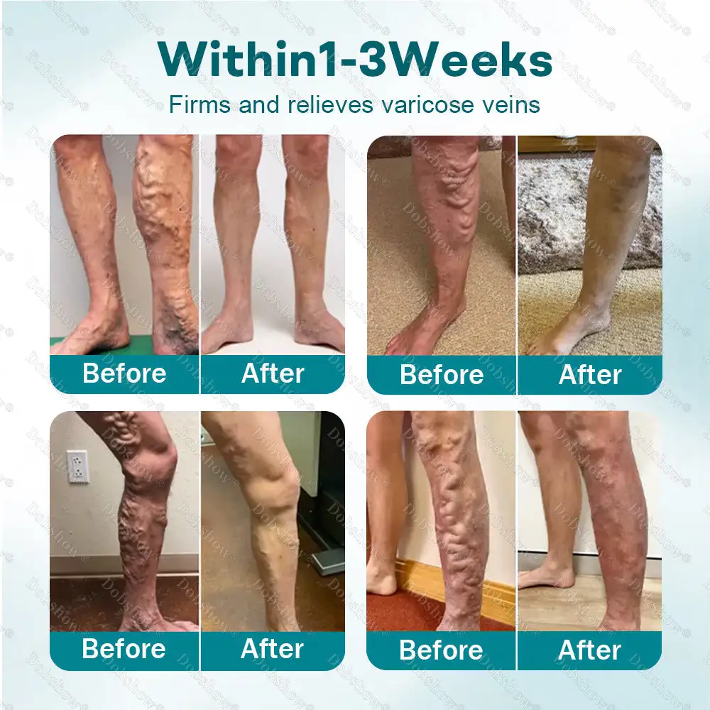 Rapid Vein Relief Microdarts - Image 2