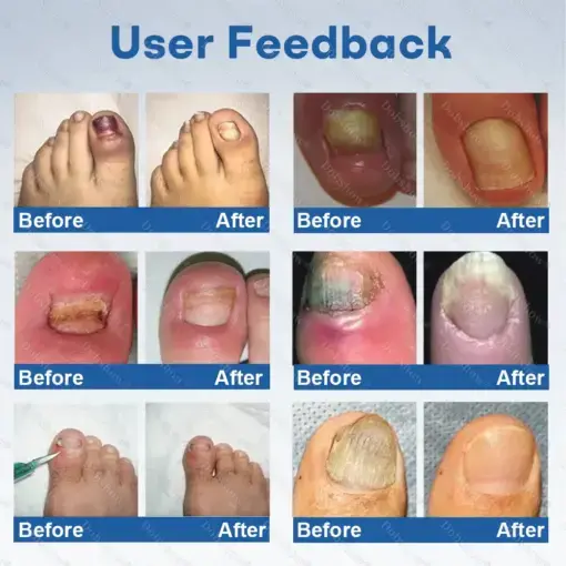 Nano Rapid Clear Nail Fungus Rapair Liquid Effective in 7 Days, Permanently Eliminates the Root - Image 4