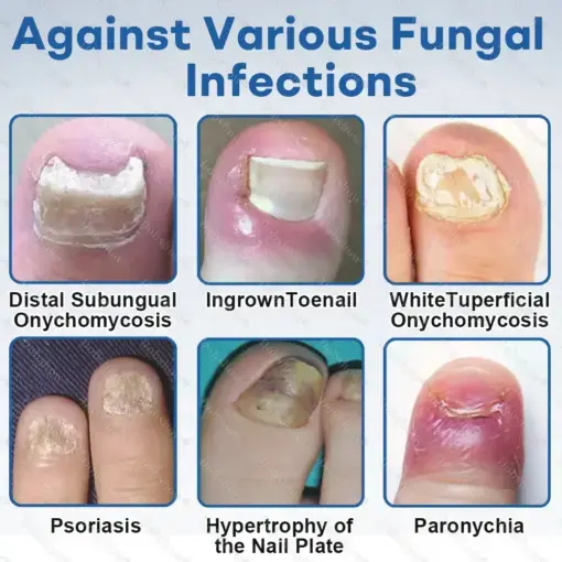 Nano Rapid Clear Nail Fungus Rapair Liquid Effective in 7 Days, Permanently Eliminates the Root - Image 8