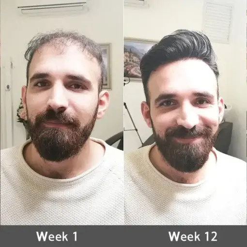 Highly Effective Biotin & Rosemary Hair Growth Serum - Image 3