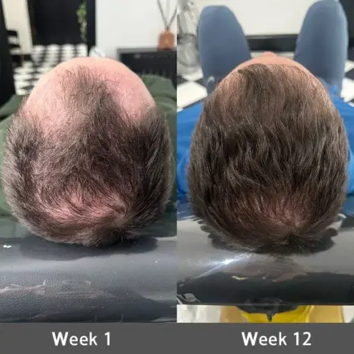 Highly Effective Biotin & Rosemary Hair Growth Serum - Image 4