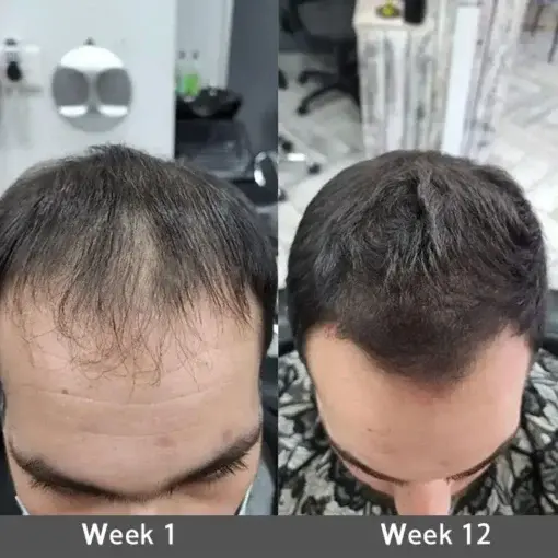 Highly Effective Biotin & Rosemary Hair Growth Serum - Image 5