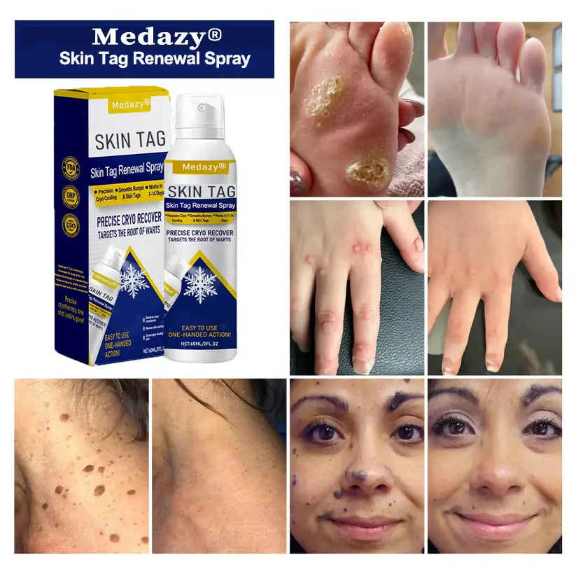 Skin Tag Renewal Spray- Reducing nutrient supply to damaged tissue and accelerating its natural shedding process - Image 2