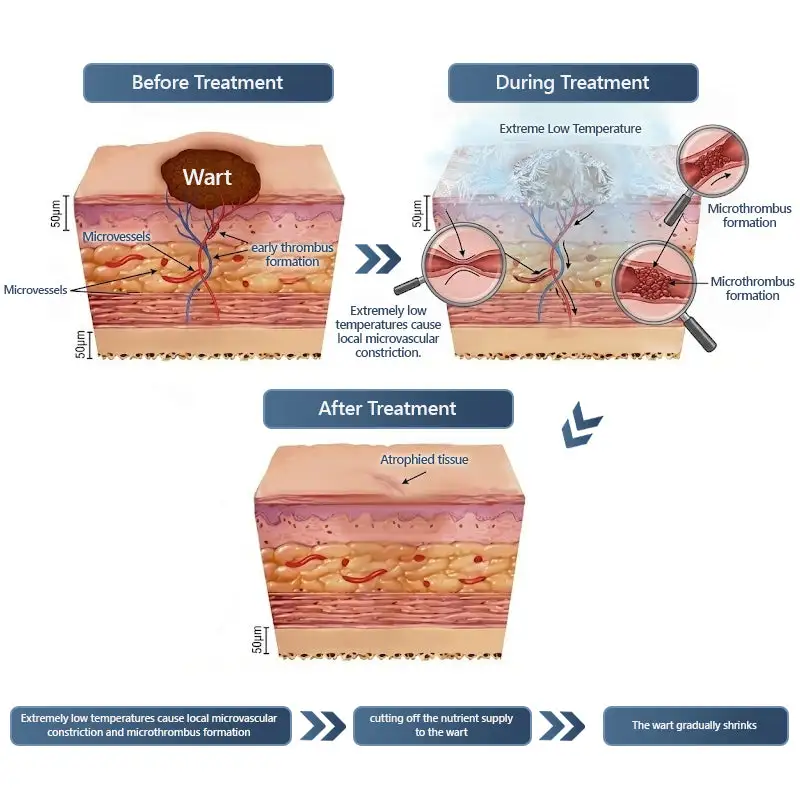 𝑽𝒊𝒕𝒂𝒍𝒊𝒔𝒚𝒔 𝑷𝒂𝒊𝒏𝒍𝒆𝒔𝒔 𝑩𝒊𝒐-𝑪𝒓𝒚𝒐𝒈𝒆𝒏 𝒕𝒆𝒄𝒉𝒏𝒐𝒍𝒐𝒈𝒚 𝑹𝒆𝒎𝒐𝒗𝒂𝒍 𝑾𝒂𝒓𝒕 𝑺𝒑𝒓𝒂𝒚 - Image 11