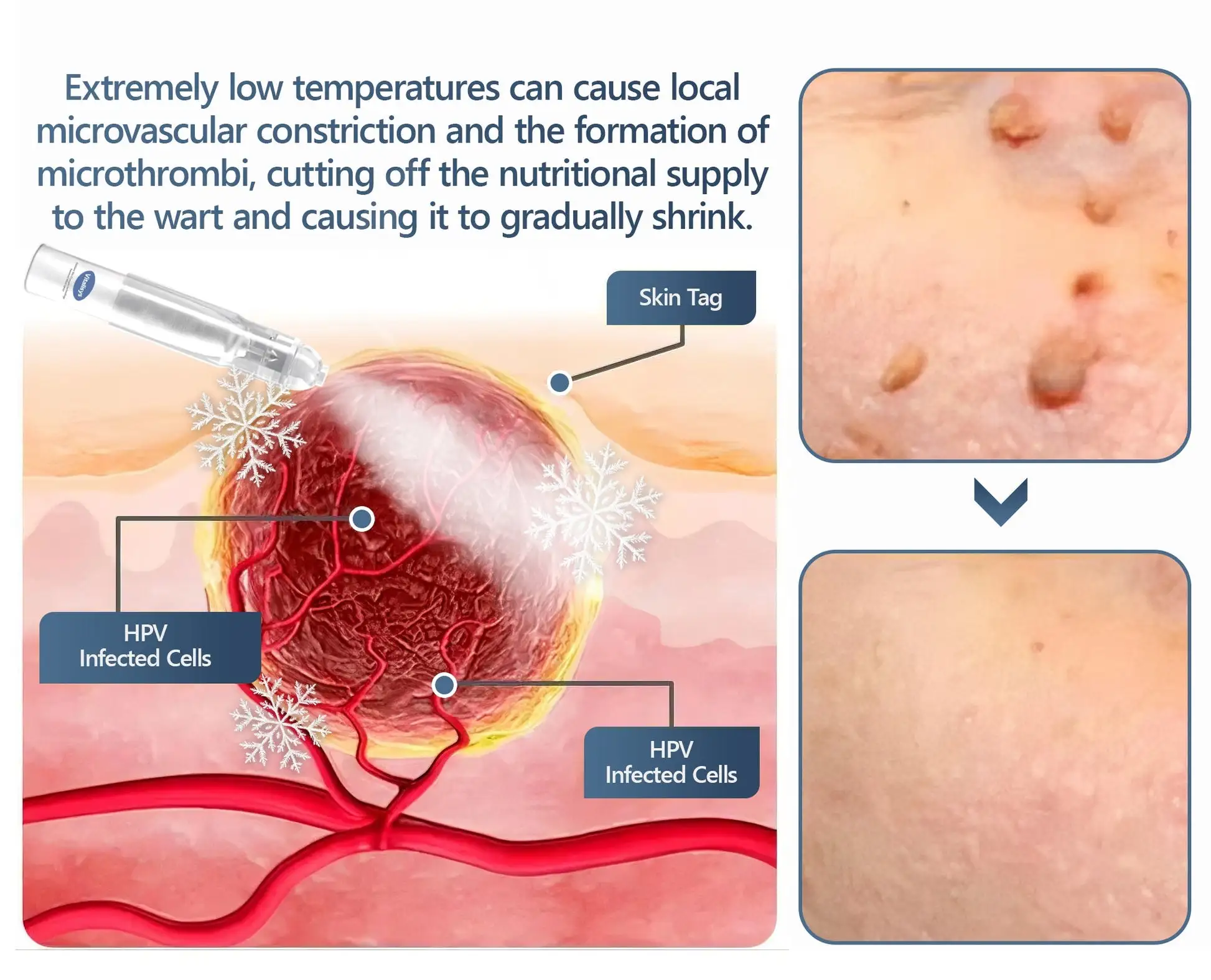 𝑽𝒊𝒕𝒂𝒍𝒊𝒔𝒚𝒔 𝑷𝒂𝒊𝒏𝒍𝒆𝒔𝒔 𝑩𝒊𝒐-𝑪𝒓𝒚𝒐𝒈𝒆𝒏 𝒕𝒆𝒄𝒉𝒏𝒐𝒍𝒐𝒈𝒚 𝑹𝒆𝒎𝒐𝒗𝒂𝒍 𝑾𝒂𝒓𝒕 𝑺𝒑𝒓𝒂𝒚 - Image 12