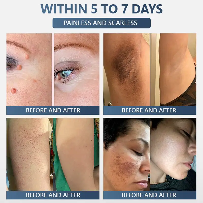 𝑽𝒊𝒕𝒂𝒍𝒊𝒔𝒚𝒔 𝑷𝒂𝒊𝒏𝒍𝒆𝒔𝒔 𝑩𝒊𝒐-𝑪𝒓𝒚𝒐𝒈𝒆𝒏 𝒕𝒆𝒄𝒉𝒏𝒐𝒍𝒐𝒈𝒚 𝑹𝒆𝒎𝒐𝒗𝒂𝒍 𝑾𝒂𝒓𝒕 𝑺𝒑𝒓𝒂𝒚 - Image 7