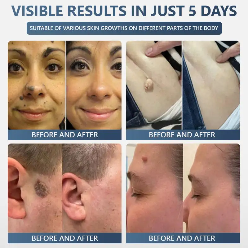 𝑽𝒊𝒕𝒂𝒍𝒊𝒔𝒚𝒔 𝑷𝒂𝒊𝒏𝒍𝒆𝒔𝒔 𝑩𝒊𝒐-𝑪𝒓𝒚𝒐𝒈𝒆𝒏 𝒕𝒆𝒄𝒉𝒏𝒐𝒍𝒐𝒈𝒚 𝑹𝒆𝒎𝒐𝒗𝒂𝒍 𝑾𝒂𝒓𝒕 𝑺𝒑𝒓𝒂𝒚 - Image 8