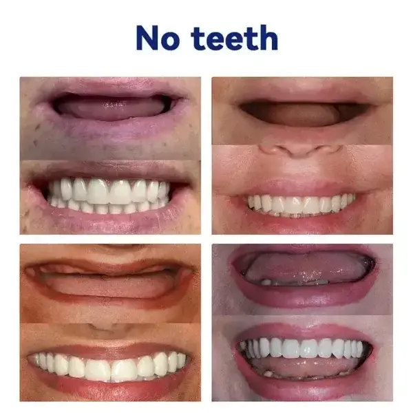 Ease Dentures - Image 3