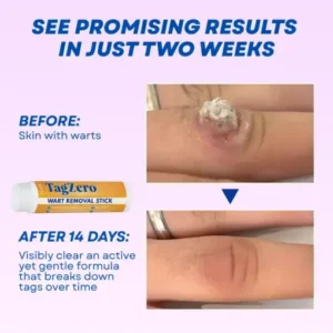 Alternative view of TagZero Wart Removal Stick