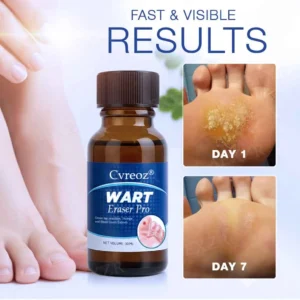 Alternative view of 🔥Warts No More - 50% OFF | Wart Eraser Pro