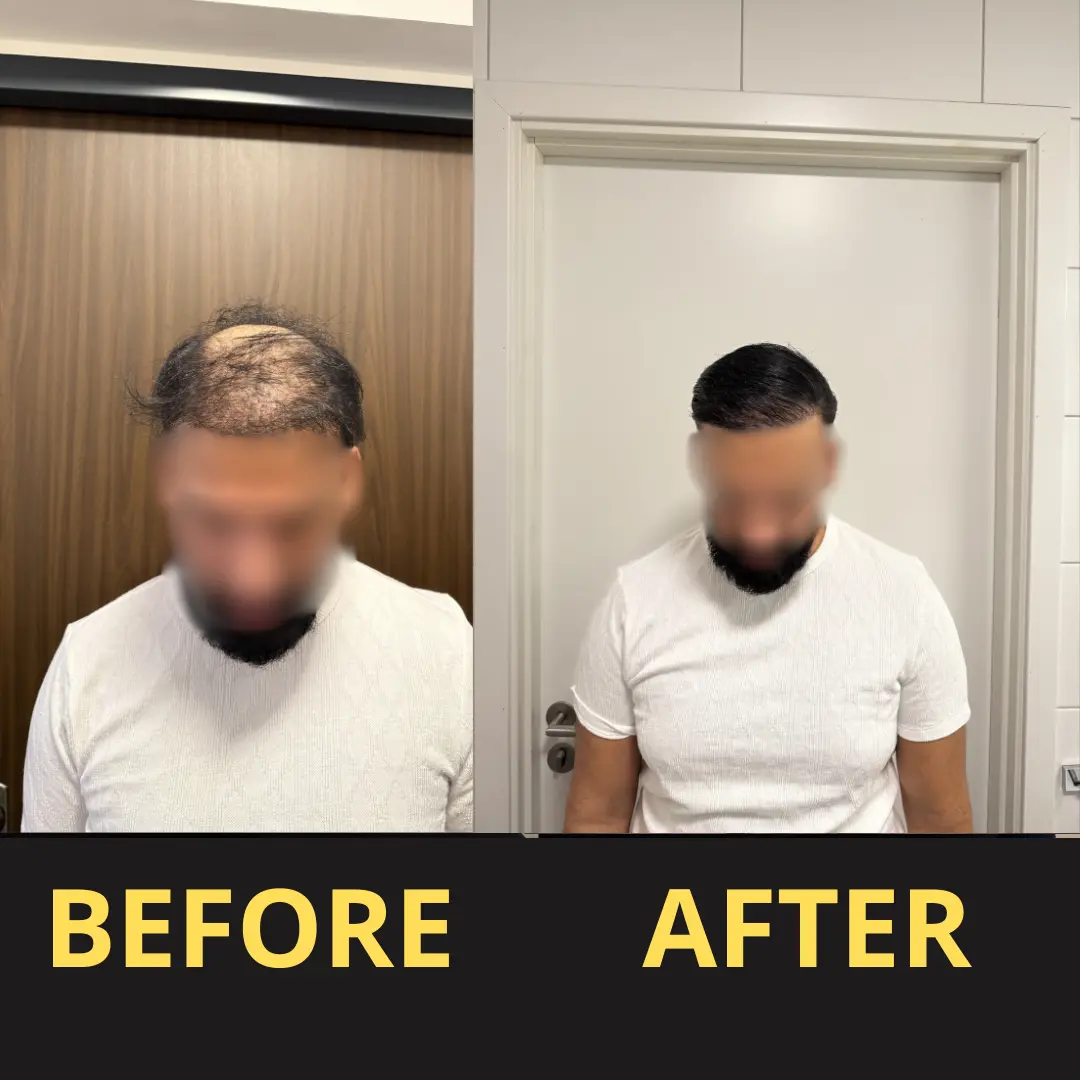 Yagoo Hair Concealer 50ML - Waterproof 3–7 days. - Image 14