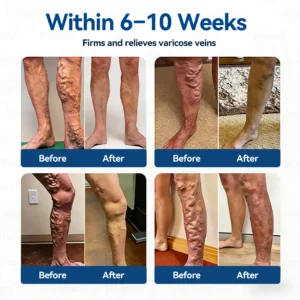 Alternative view of 𝐕𝐞𝐢𝐧 𝐂𝐨𝐧𝐭𝐨𝐮𝐫 𝑪𝒍𝒊𝒏𝒊𝒄𝒂𝒍-𝑮𝒓𝒂𝒅𝒆 𝑭𝒐𝒓𝒎𝒖𝒍𝒂 𝑴𝒊𝒄𝒓𝒐𝒏𝒆𝒆𝒅𝒍𝒆 𝑷𝒂𝒕𝒄𝒉