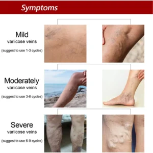 Alternative view of Varicose Veins Relief Cream