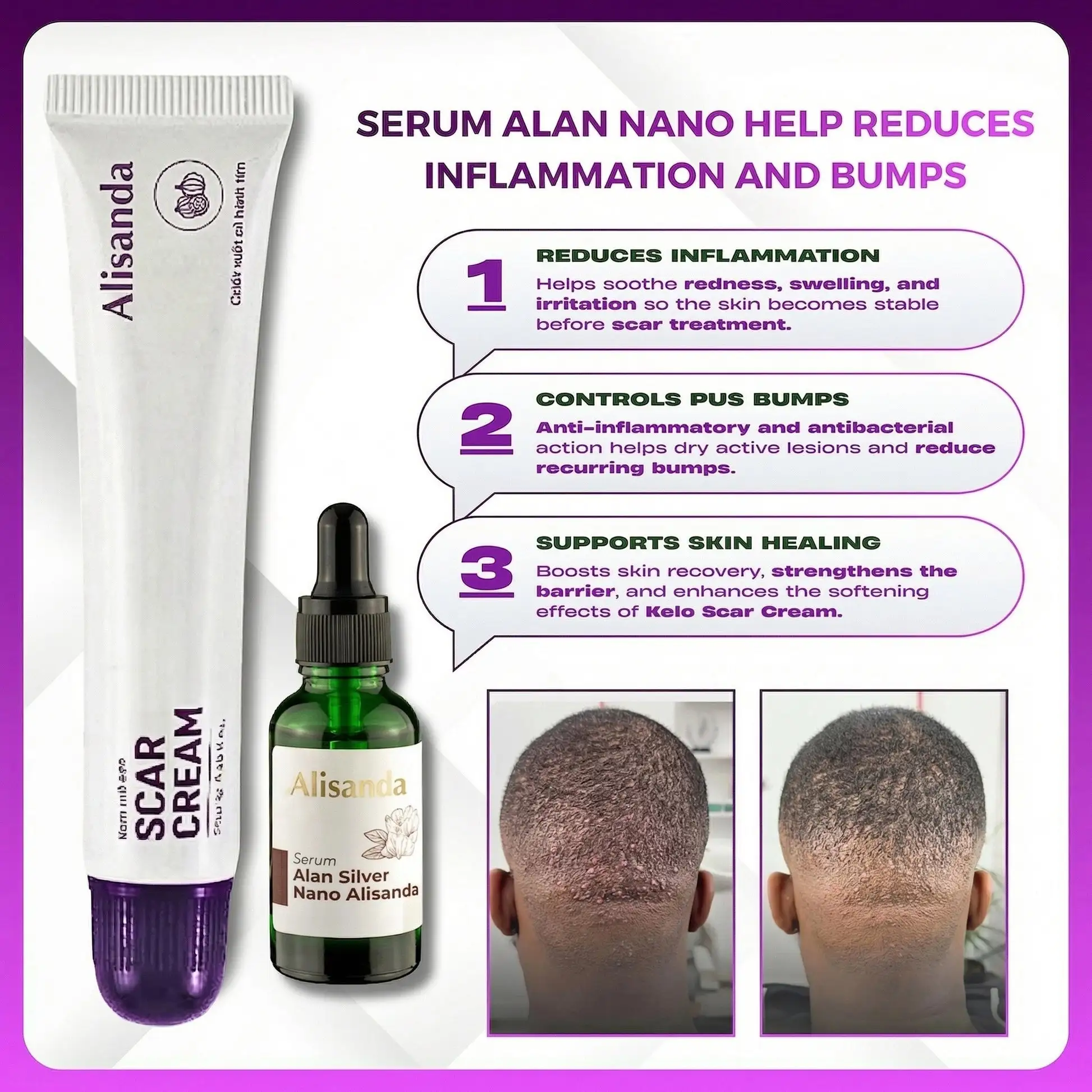 Alisanda Scar Cream – Advanced Treatment for Raised & Keloid Scars - Image 3