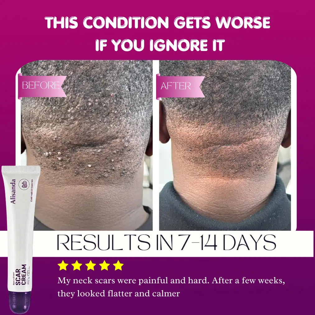 Alisanda Scar Cream – Advanced Treatment for Raised & Keloid Scars - Image 5
