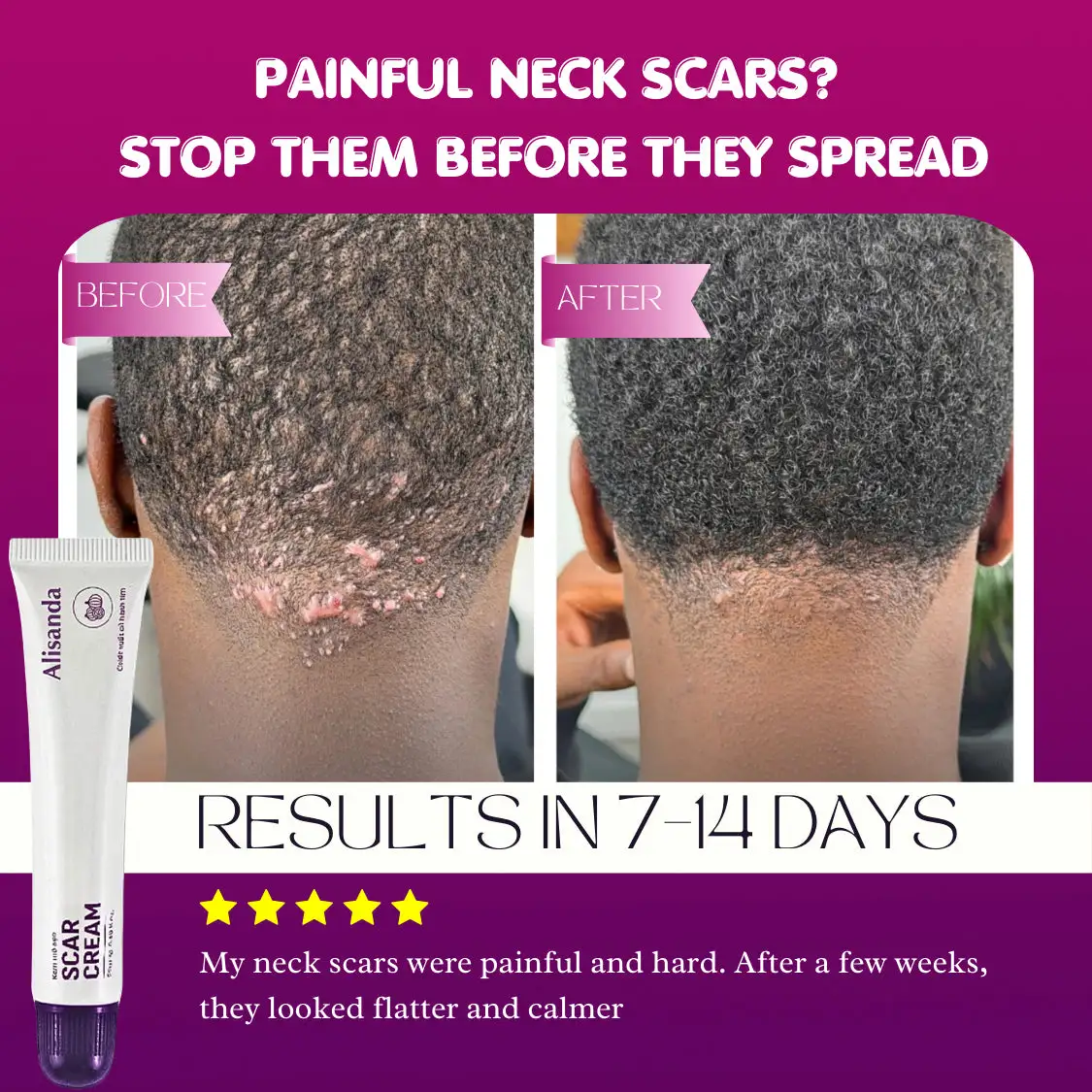 Alisanda Scar Cream – Advanced Treatment for Raised & Keloid Scars - Image 6