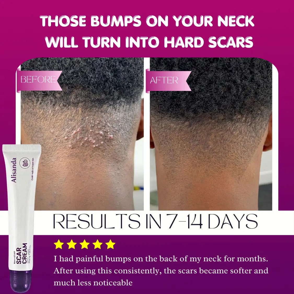 Alisanda Scar Cream – Advanced Treatment for Raised & Keloid Scars - Image 7