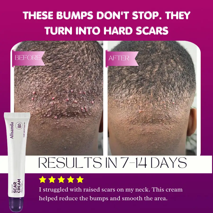 Alisanda Scar Cream – Advanced Treatment for Raised & Keloid Scars - Image 8