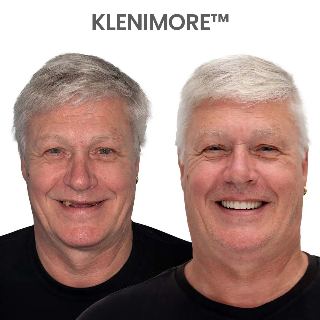 ⏰ Custom-Fit Dentures ENDS TODAY 70% OFF | Smile with Confidence - Image 17