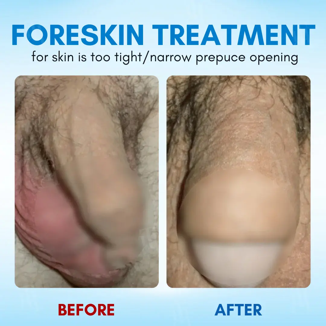 Foreskin Elasticity Gel:The Non-Surgical Solution for Tight Foreskin - Image 2