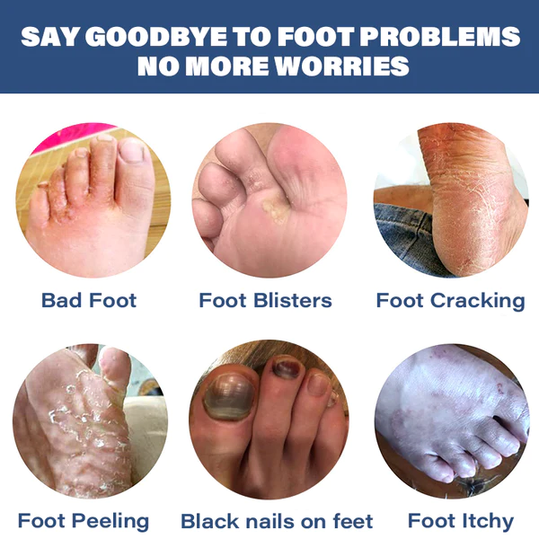 Medical grade fungal nail fungus foot spray - Image 6