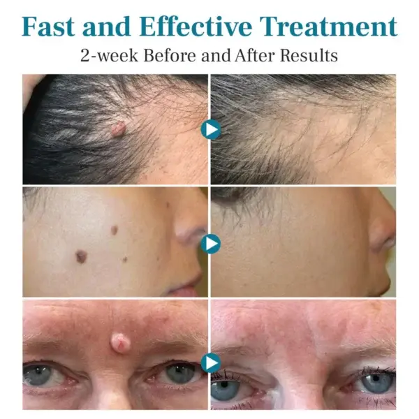 LumeSkin Mole and Wart Removal Laser Pen - Image 6