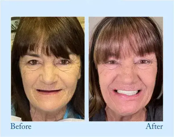 Dentures - Image 10