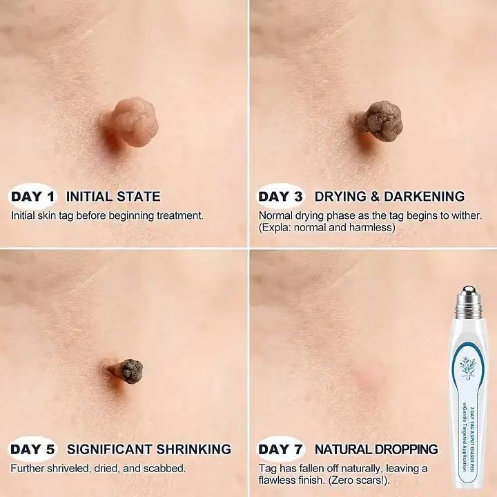 7-Day Skin Tag & Spot Eraser Painless & Scar-Free Advanced Imperfection Removal Rollerball Pen - Image 4