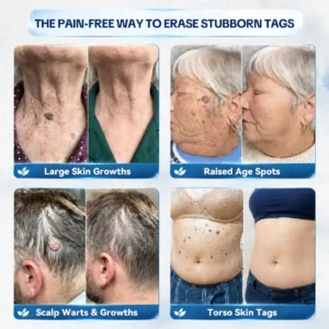 Alternative view of 7-𝐃𝐚𝐲 𝐒𝐤𝐢𝐧 𝐓𝐚𝐠 & 𝐒𝐩𝐨𝐭 𝐄𝐫𝐚𝐬𝐞𝐫 𝐂𝐫𝐞𝐚𝐦