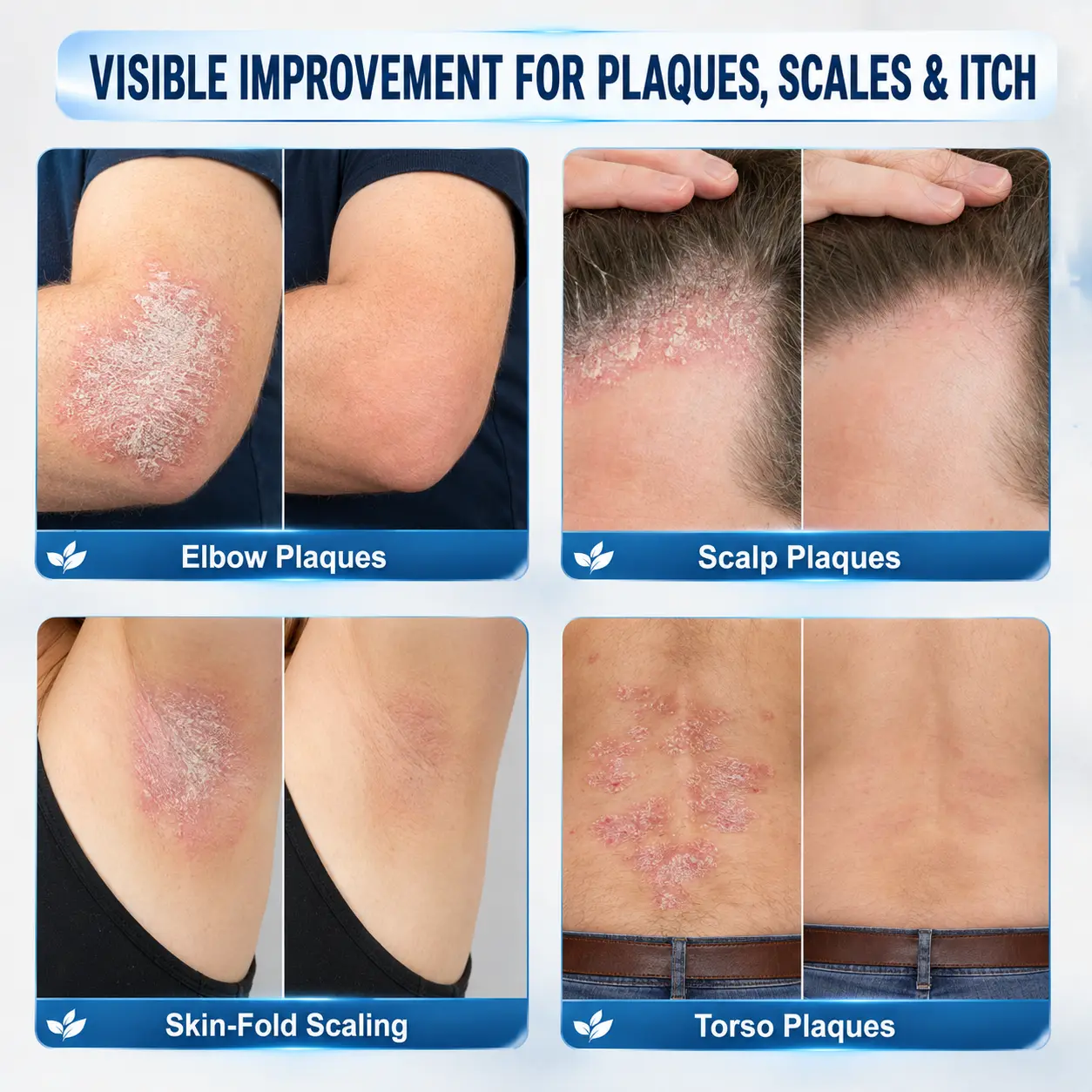 Calming Care for Psoriasis-Prone Skin 7-Day Soothing Roll - Image 2