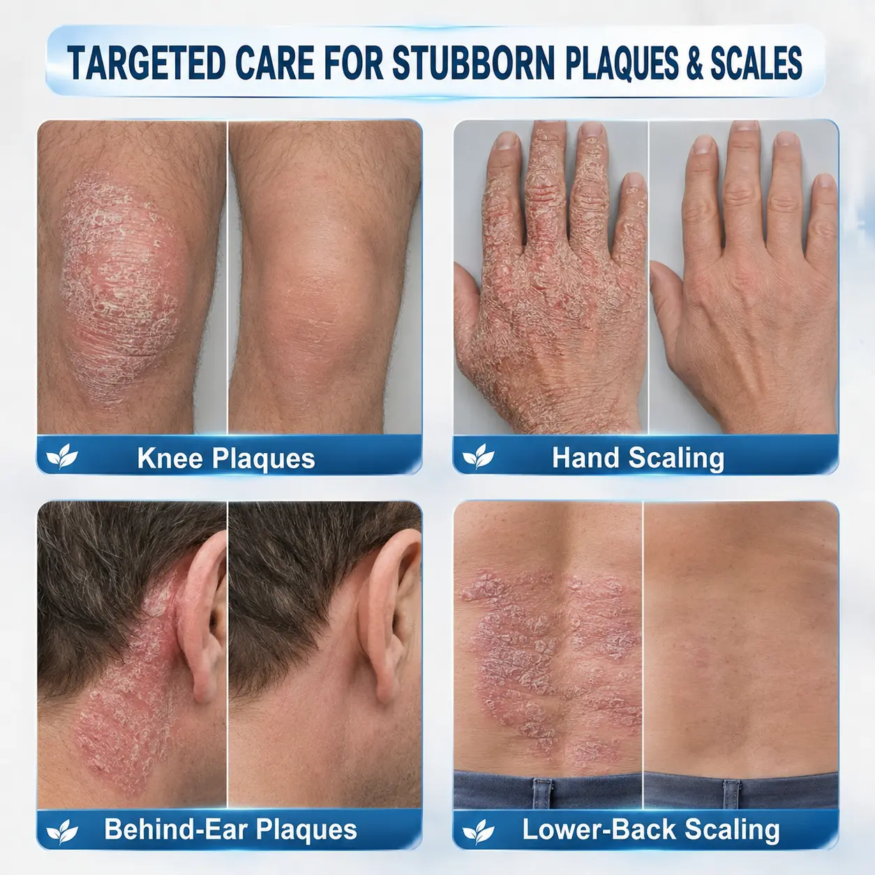 Calming Care for Psoriasis-Prone Skin 7-Day Soothing Roll - Image 3