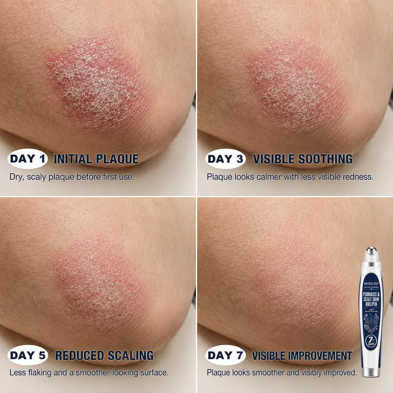 Calming Care for Psoriasis-Prone Skin 7-Day Soothing Roll - Image 4