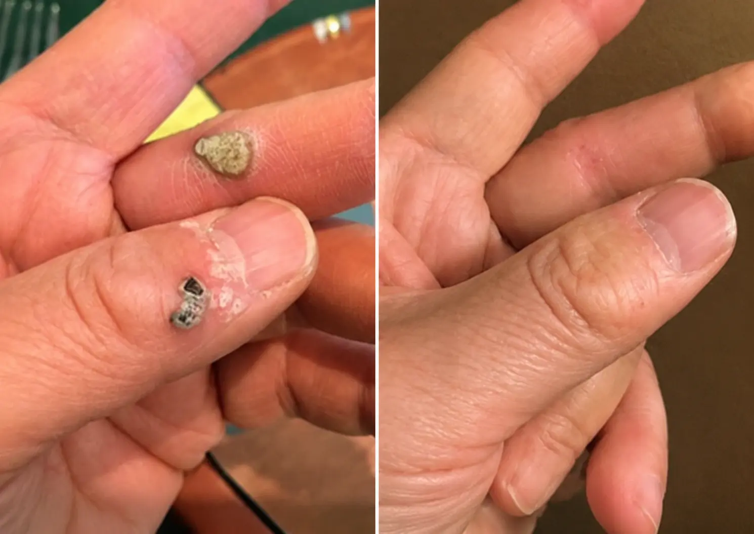 2-in-1 Microneedle & Hydrocolloid Patch - Image 10