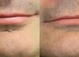 2-in-1 Microneedle & Hydrocolloid Patch - Image 12