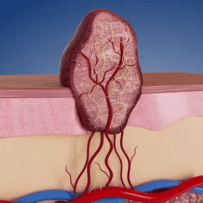Parche 2 en 1 de Microneedles e Hidrocoloide - Image 2