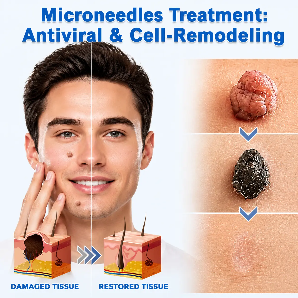Parche 2 en 1 de Microneedles e Hidrocoloide - Image 6