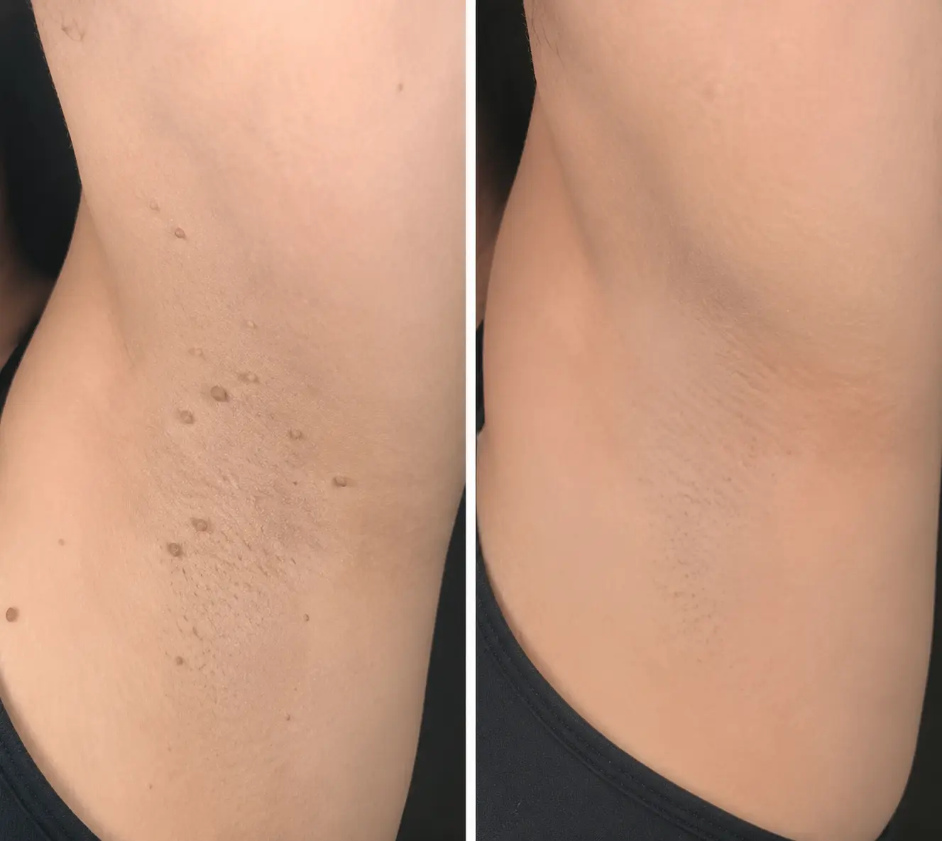 Parche 2 en 1 de Microneedles e Hidrocoloide - Image 9