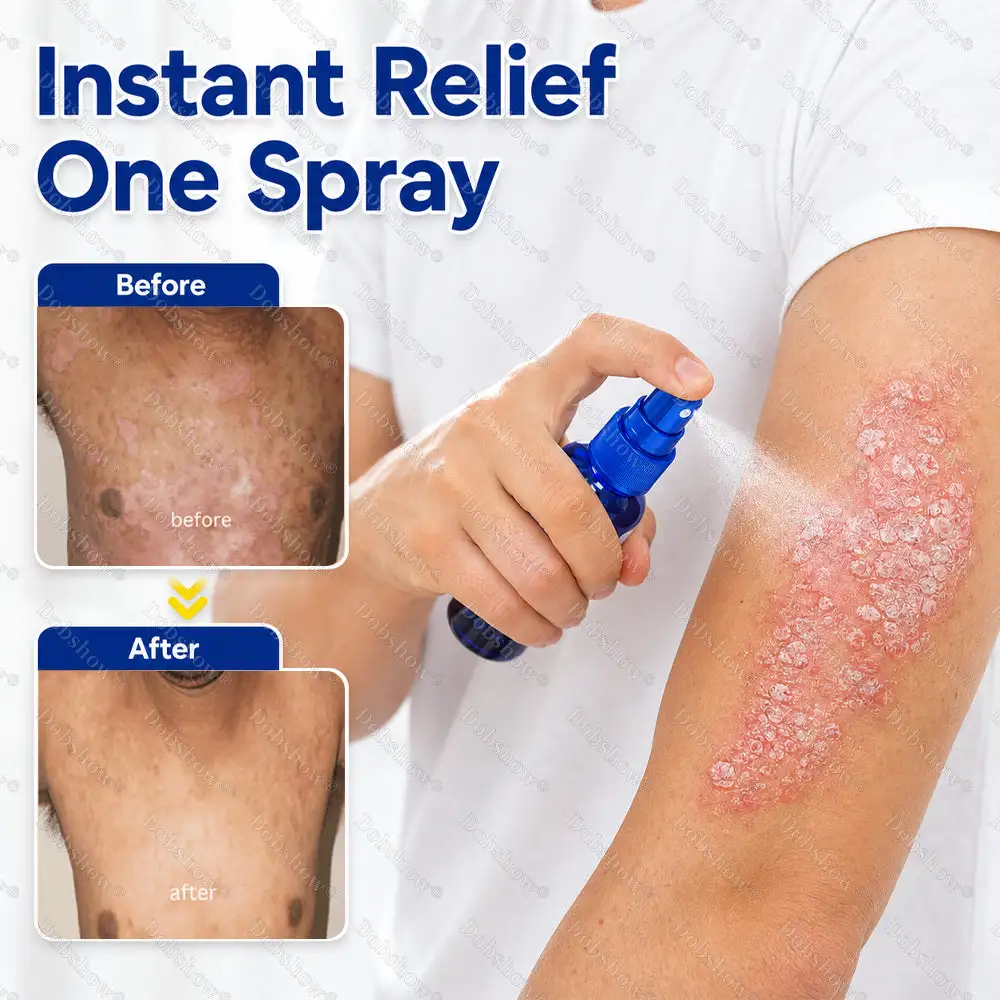 Advanced Psoriasis Relief Spray - Image 2