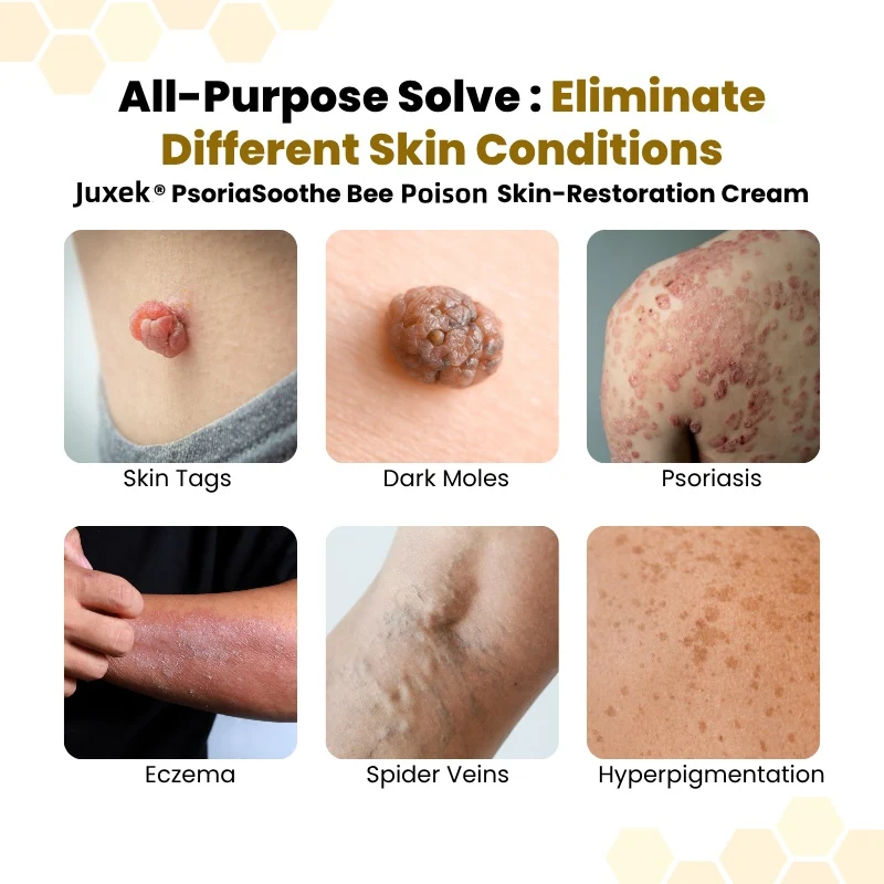 PsoriaSoothe Bee Poison Skin Restoration Cream - Image 2