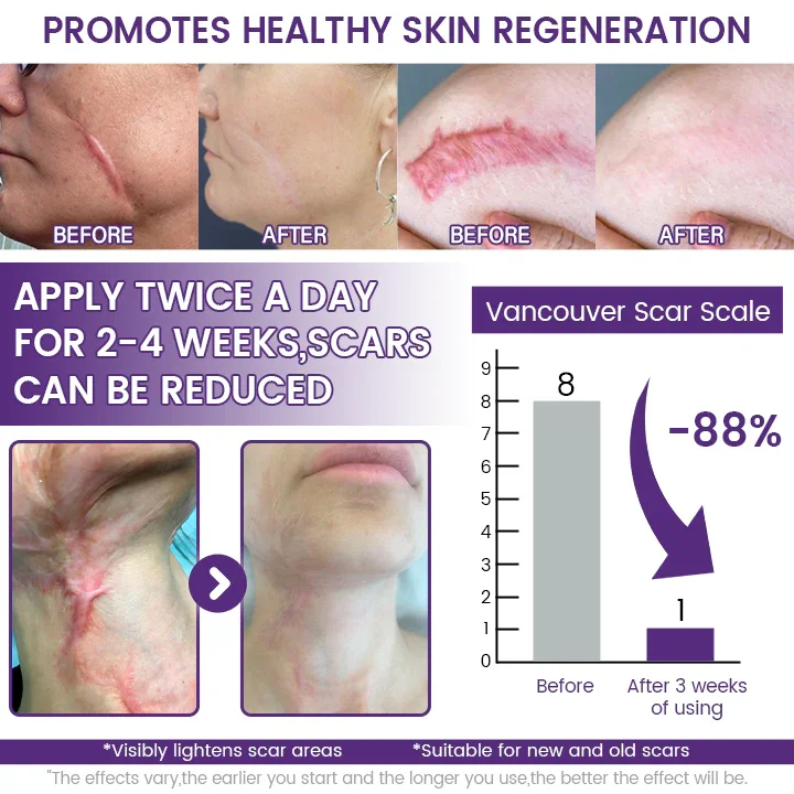 LOVILDS ReGenScar Stem Cell Scar Gel - Image 2