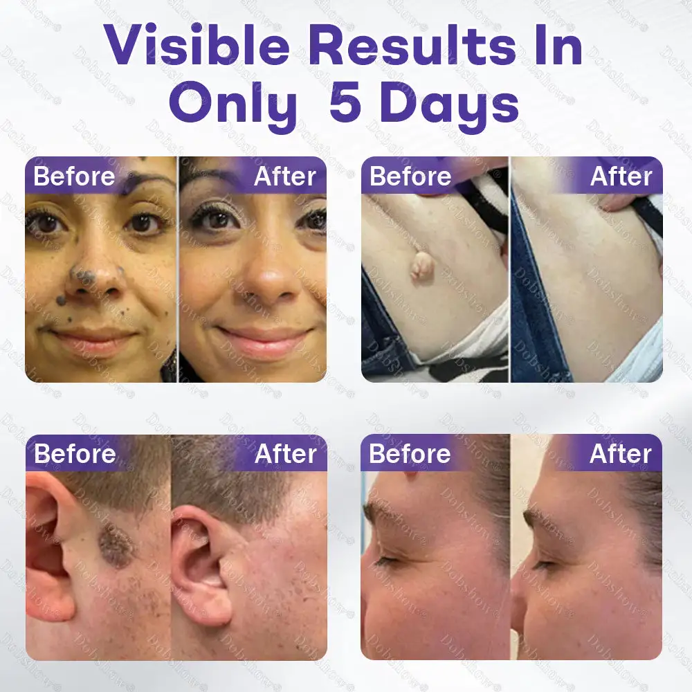 Wart and Mole Removal Microneedle Patch - Image 3