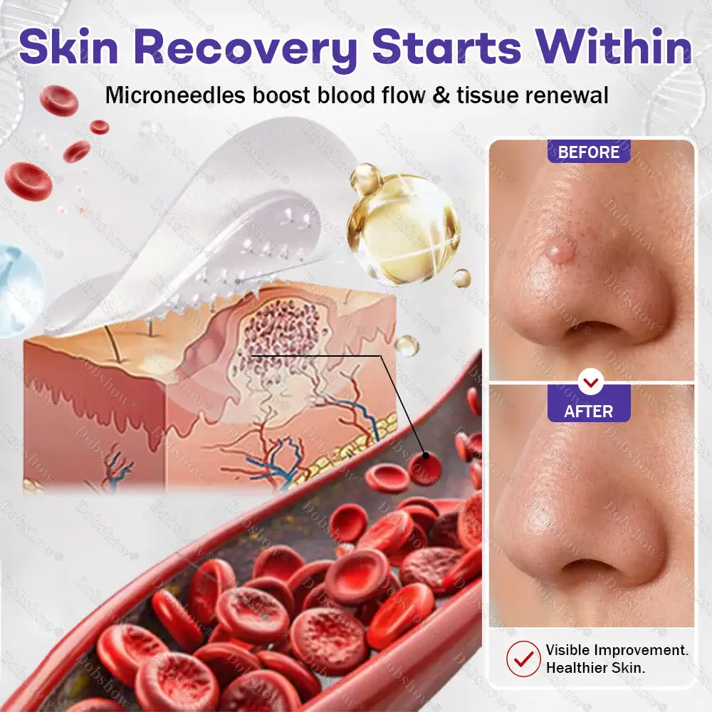 Wart and Mole Removal Microneedle Patch - Image 5