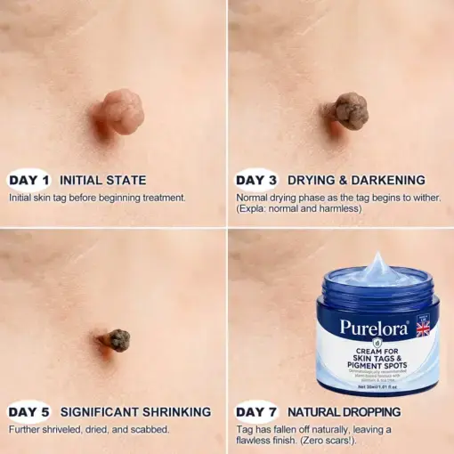 Targeted Skin Tag & Spot Care Cream - Image 4