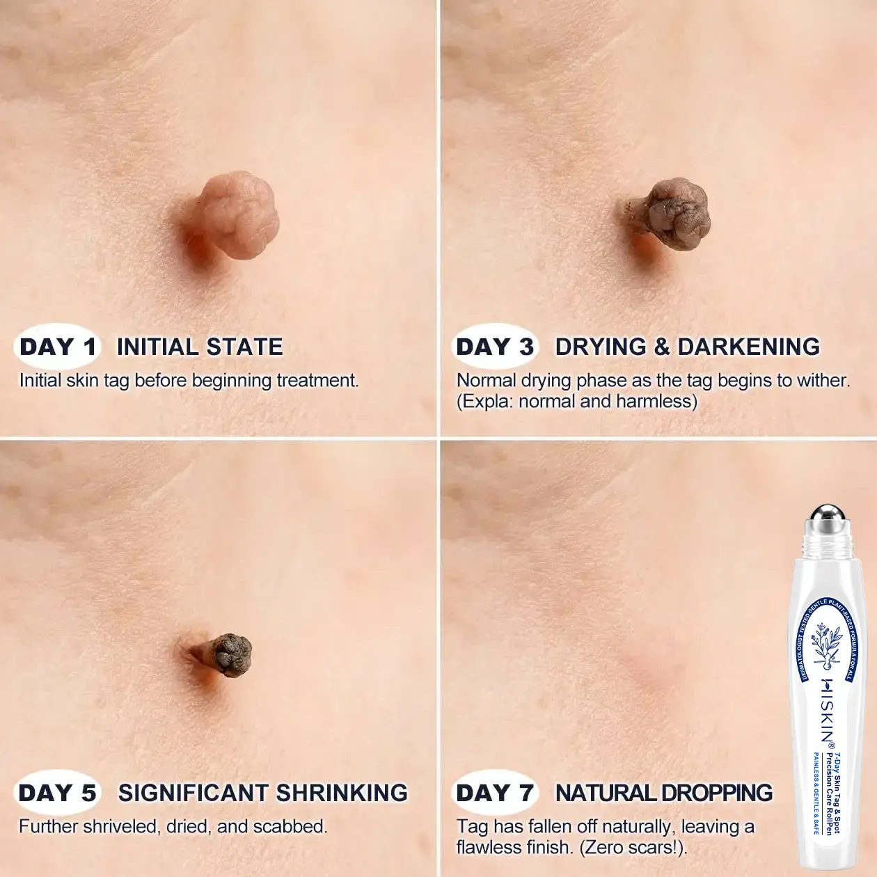 ๐-๐๐๐ ๐๐ธ๐ข๐ง ๐๐๐ด & ๐๐ฉ๐ค๐ญ ๐๐ซ๐๐ฌ๐๐ซ Painless & Scar-Free Advanced Imperfection Removal Rollerball Pen - Image 4