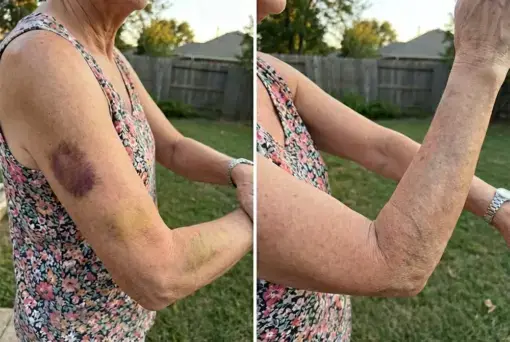 Bruise & Visible Marks Cream - Image 7