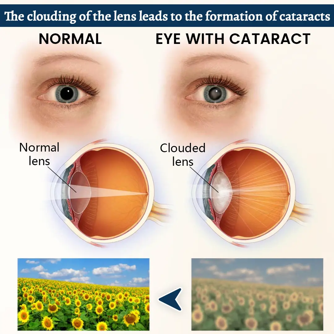 OptiFusion Vision Support Eye Patch - Image 5